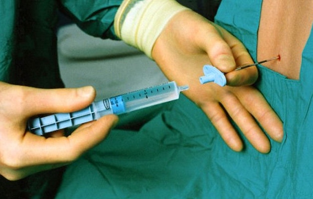 укол блокада в позвоночник