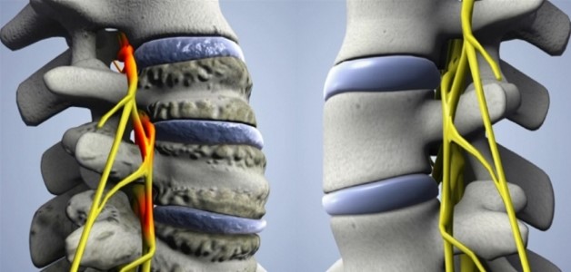 унковертебральный артроз