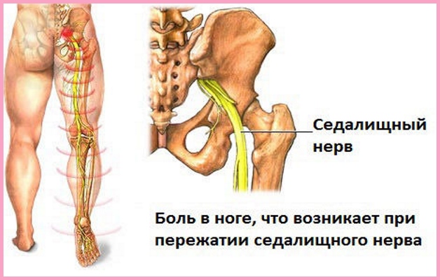 ущемление нерва
