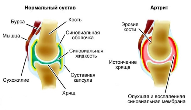Видоизменение сустава при воспалении