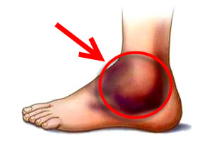 Воспаленный голеностопный сустав