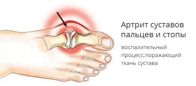 Воспалительный процесс в тканях сустава